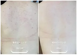 モニター募集🪡背中全体<7日間改善プログラム>剥離有ピーリング◎1週間で背中つるつる🫧ニキビ跡/ニキビ/色素沈着