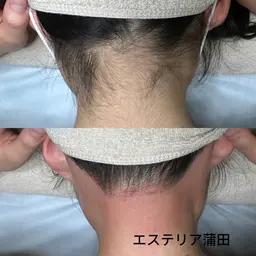 うなじW脱毛+もみあげW脱毛 ￥8000⇒￥7000