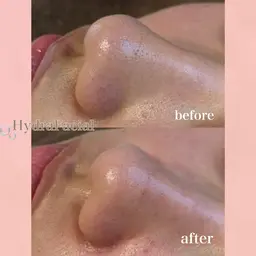 【大人気】🫧お顔丸ごと毛穴洗浄🫧|水光肌ケア|ハイドラフェイシャル 肌質改善・黒ずみ/ざらつき/ニキビ卒業！！