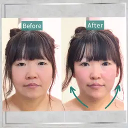 人気No.1【最強小顔】美容鍼/ラジオ波!顔・頬のお肉/脂肪/二重あご改善120分