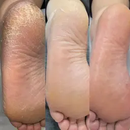 エンザイム角質ビットケア®︎メンズOK