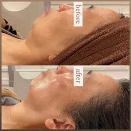 【フェイシャル人気NO.1】気になるお悩み解消✨小顔ハイパーナイフで最強リフトアップ🔥[心斎橋]