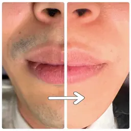 【ご新規様限定】おヒゲ①パーツ脱毛