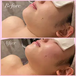 小顔&むくみ・肩こり❣️RF波フェイシャル