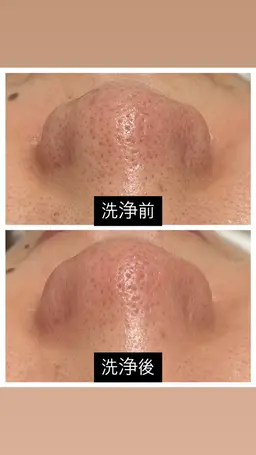 【ダウンタイム・剥離なし⠀】ハイドラフェイシャル・水流ピーリング