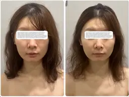 24歳以下限定!【小顔・肩こり】小顔矯正ヘッドスパ+腕肩のオイルマッサージ