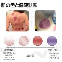 中国式肩こり、腰痛、浮腫、冷え性女性特有の辛さ脱出全身コース カッピングで、巡る身体に!