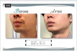 【men'sメニュー】お試し　ヒゲ脱毛