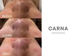 【Byebye角栓！毛穴レス肌へ】全顔★超音波毛穴洗浄（ハイドラ）