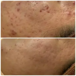 📍平日10-15時限定📍しつこいニキビ/繰り返すニキビ痕/毛穴/黒ずみ/天然温泉HOTパックつき♨️✨