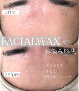 ✨新メニュー導入✨フェイスワックス脱毛［モニター価格］