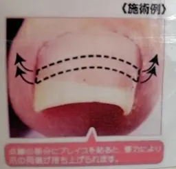 フット・BSブレイス【巻き爪矯正】1本