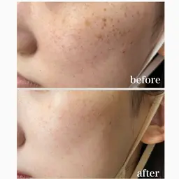 シミケア　（10ショット）