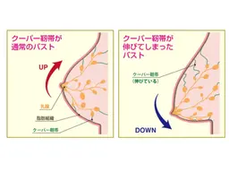 産後・授乳後の下垂したバストを改善します
