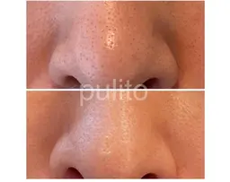 モニター募集！！角栓が詰まっている方|SNS写真okな方限定|ハイドロスキンビタミン導入つき♪角栓除去！吹出物改善！