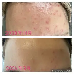 人気No.1🌿毛穴・ニキビケアフェイシャル 2回コース