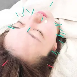 肌荒れ改善・リフトアップ効果⭐️美容鍼のみ