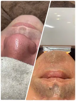 【メンズ脱毛】ヒゲ脱毛+顔全体毛穴洗浄ハイドラ 顔マッサージ付き 15,000円→8,800円