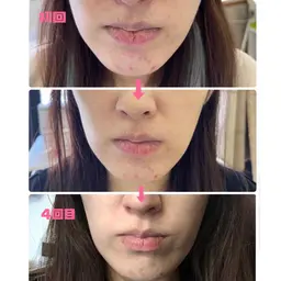 【4週間でぐぐっとキレイ😍】4回超音波エステ&9680円分のスキンケアセット付き✨1ヶ月で自分の新しい綺麗に出会う💕