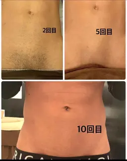 【4月限定】 🌸(男性VIO脱毛)🌸平均15回でつるつるに🌸2回目以降は5,000円🌸