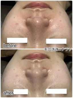 【黒ずみ開き毛穴・くすみケアNo.1👑】タラソトリートメント🫧