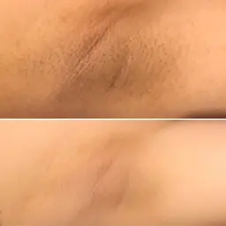レディス【ワキ・脱毛】当日予約不可❌脱毛しながら、美肌効果も抜群💖