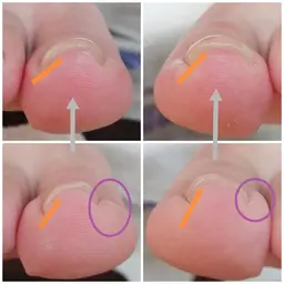 痛みなし！巻き爪ケアジェル