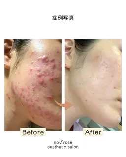 【モニター様限定】revi陶肌トリートメント(剥離なしハーブピーリング)orアクアピール(韓国大人気の美容液ピーリング)