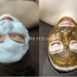 人気No.1👑《ニキビ/シミケア》メディカルハーブピーリング🌿剥離なしで陶器肌✨