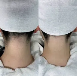 【 うなじ脱毛+シェービング 】後ろ姿美人へ🦢🏹