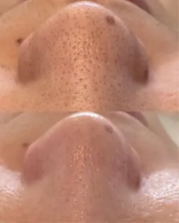 【結果重視】毛穴徹底洗浄×吸引×鎮静ケア※鼻のみ