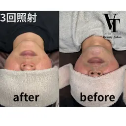 【メンズ初回限定】まずは効果を実感してください！ヒゲ脱毛🧔🧔‍♂️