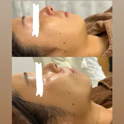 フェイスライン集中リフト！サーマトリックス3パーツで横顔が変わる✨