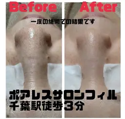 アルティメイトクイック毛穴洗浄30分＋全顔シェービング付🌷お鼻の黒ずみ気にされてる方⭕️シェービングで透明感アップ🌟