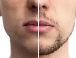 メンズひげ脱毛