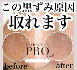 【毛穴美人】毛穴エクストラクションプロ(ヘッドスパorデコルテ付)