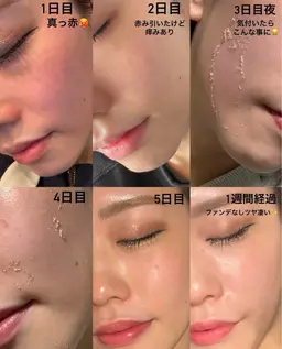 ハーブピーリング(剥離あり・ダウンタイム約1週間) ニキビ・ニキビ跡・色素沈着・広い毛穴に効果的