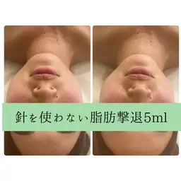 新春☘️モニター☘️針を使わない脂肪撃退🌸後戻り0🙆‍♀️お顔¥19,800⇨¥7000