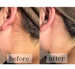 綺麗なデザインに🌸うなじ脱毛(シェービング付き)✨後ろ姿美人に