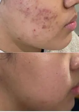 ハーブピーリング 女性