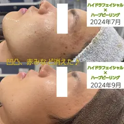 【初回体験】ニキビ跡があるメンズにもおすすめ！徹底毛穴！ツルピカ水光肌✨ハイドラフェイシャル&ハーブピーリング🌿