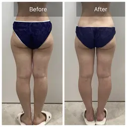 🉐16日以内再来店価格【結果重視◎本気ダイエット】痩身マシン3種&全身コルギ120分¥24800→12500