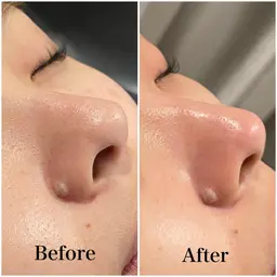 毛穴黒ずみ・ニキビ・小顔★　毛穴洗浄→鼻周りハーブピーリング→導入リフト