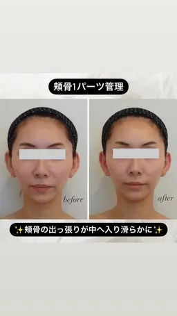 【本物の小顔矯正】痛みなし❣️オールハンドで叶う✨整形級小顔40分