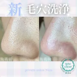 鼻の毛穴エクストラクション🌈イチゴ鼻・ざらつき解消!吸引では取り除けない角栓を手技で丁寧にごっそり大掃除‼︎