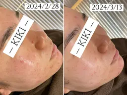 【68％オフ‼️】【ハーブピーリング｜毛穴黒ずみケア◎】カウンセリング込み120min(31,900円→10,000円)