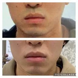 ミニモ学割★今なら2回×20分1000円【メンズ様☆大人気❣️】髭・vioに特化!毎日のめんどうな髭剃りからも卒業です