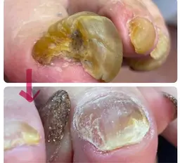 巻き爪、肥厚爪、陥入爪、魚の目ケア、タコケア爪トラブルご相談受けます🙆