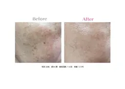 【夏前ケア✨】全身美脱毛(顔+vio)+美肌フェイシャル