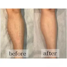 レディース全身脱毛(顔・VIO込み)🌸